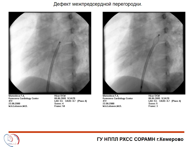 ГУ НППЛ РХСС СОРАМН г.Кемерово Дефект межпредсердной перегородки.